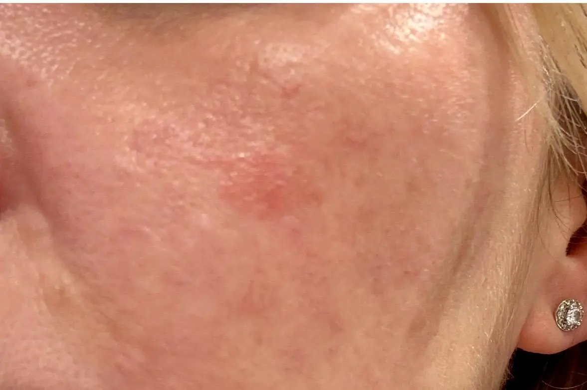 Before skincare treatment plan progress